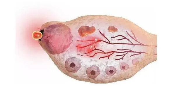 多囊卵巢综合症排卵吗？直接用促排卵的药可以吗？