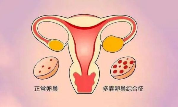 多囊的卵泡一般长多大？多囊卵巢受孕几率有多大？